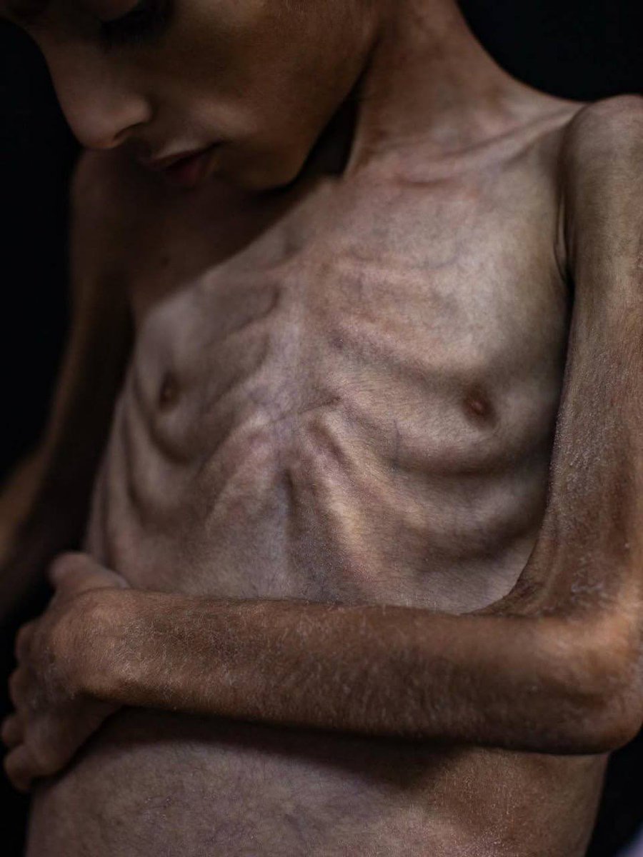 bundaathira's tweet image. Osama Al-Riqib, seorang anak berusia 5 tahun, menderita penurunan berat badan dan kelemahan tulang akibat kekurangan gizi yang disebabkan oleh penutupan perbatasan dan blokade masuknya makanan ke Gaza. 

#GazaStarving #GazaHunger #AidForGaza #OpenRafahSaveGaza