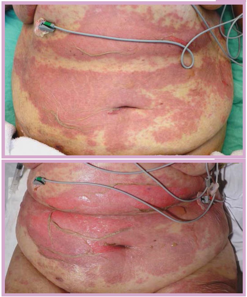 A 71 y/o woman with fever, malaise and a peeling rash involving 70% of the total body surface area. She had started a course of sulfamethoxazole–trimethoprim and ciprofloxacin for cellulitis of the right foot 8 days ago.
- What's the diagnosis ?

#medtwitter #foamed #meded