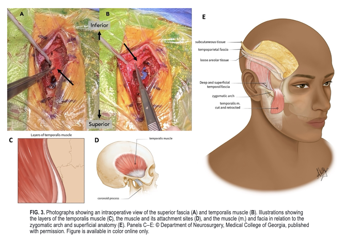 #OnlineFirst: Surgery for mesial temporal pathology: a 26-year experience. 

thejns.org/view/journals/….
