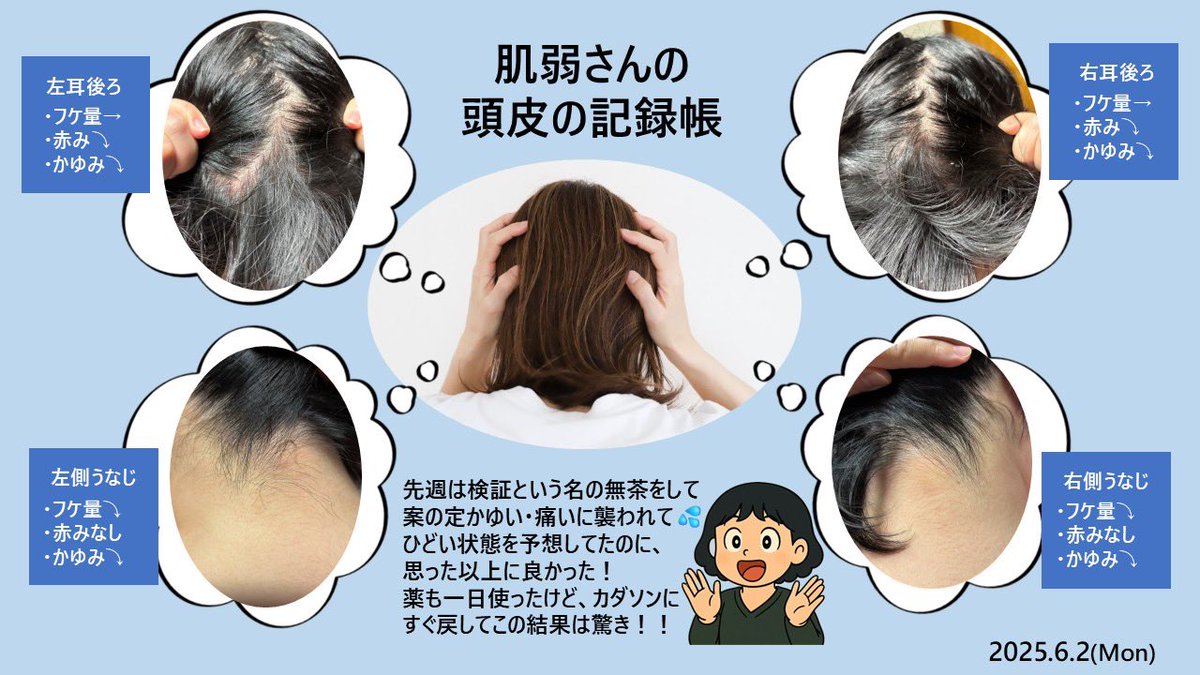 hadayowa_san's tweet photo. 頭皮の記録帳更新📝
先週検証で1日前のシャンプーに戻したらかゆみ･痛み悪化で久々に薬使用💦すぐカダソンに戻したけど今回は駄目だろうなと思ったのに…状態いい😳！フケはあるけど赤みも減ってる！
前は薬使っても戻すのに時間かかったのにカダソンが軌道修正してくれた！

#脂漏性皮膚炎
#KADASON https://t.co/U4tzYH3WbB