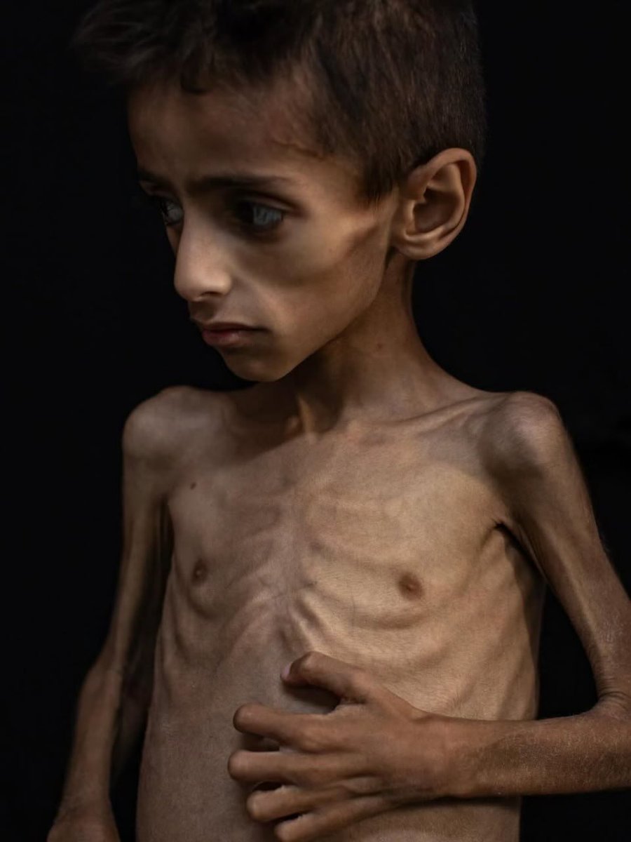 5 yaşındaki Gazzeli Usame.. 

- Gazze'de çocuklar açlıktan ölüyor..!!