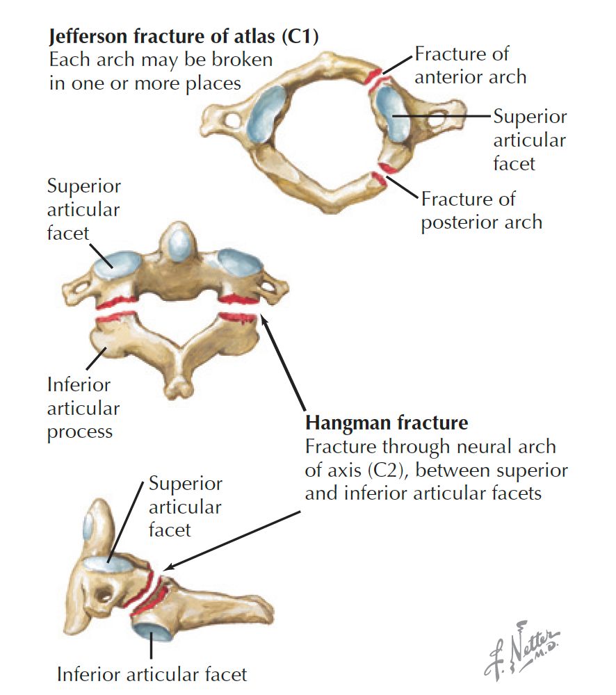 Jefferson fracture of atlas (C1) vs Hangman fracture, image size:886x1000