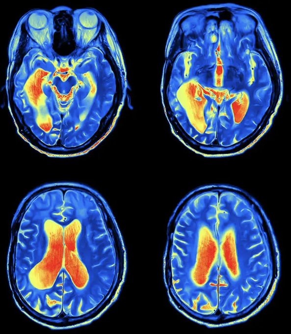 usd666666's tweet image. 这是哈佛的精神科医生克里斯·帕尔默。

他花了 25 年治疗各种精神疾病。

他发现，焦虑、忧郁、多动症的真正元凶，不是创伤，不是脑内化学失衡，而是——线粒体功能障碍。

这个发现，可能会彻底改变我们对精神病的理解方式与治疗方式🧵：
