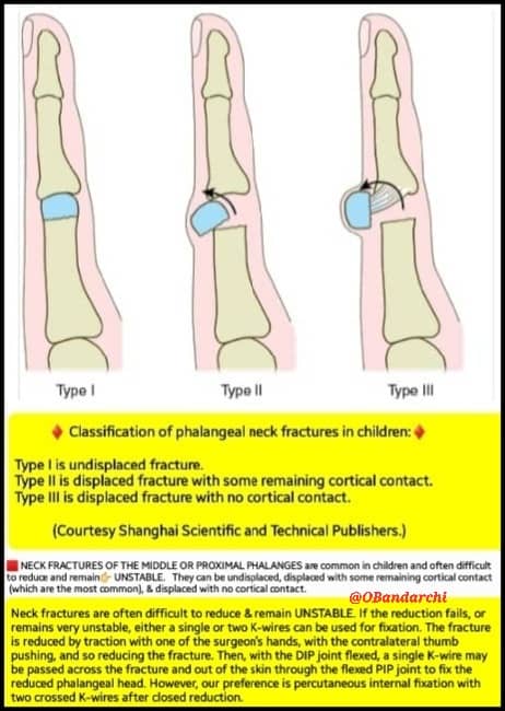 🛑NECK FX(s) OF MIDDLE or PROXIMAL PHALANGES:

Common in children;difficult to reduce &amp; remain UNSTABLE. Fx reduced by*traction...If reduction fails,either a single or two K-wires used for fixation.

Or percutaneous internal fixation with 2 crossed K-wires after closed reduction