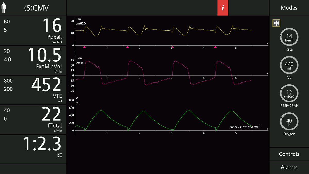 Ariel J Garnero (@arielg_rrt) on Twitter photo What is going on and why? TAG/Load? What would you do next? <a href="/DocMusician/">Doc Musician</a> <a href="/DrMiguelIbarra1/">Dr. Miguel Ibarra-Estrada</a> <a href="/emireles_c/">Eduardo Mireles-Cabodevila</a> <a href="/CCF_PCCM/">CCF Pulmonary and Critical Care Fellows</a> <a href="/SaudiRTs/">Saudi Respiratory</a> <a href="/OfVentilation/">Society of Mechanical Ventilation</a> <a href="/Vent_Busters/">VentBusters</a> <a href="/RespiratorySCCM/">SCCM Respiratory Care Section</a> What is going on and why? TAG/Load? What would you do next? <a href="/DocMusician/">Doc Musician</a> <a href="/DrMiguelIbarra1/">Dr. Miguel Ibarra-Estrada</a> <a href="/emireles_c/">Eduardo Mireles-Cabodevila</a> <a href="/CCF_PCCM/">CCF Pulmonary and Critical Care Fellows</a> <a href="/SaudiRTs/">Saudi Respiratory</a> <a href="/OfVentilation/">Society of Mechanical Ventilation</a> <a href="/Vent_Busters/">VentBusters</a> <a href="/RespiratorySCCM/">SCCM Respiratory Care Section</a>