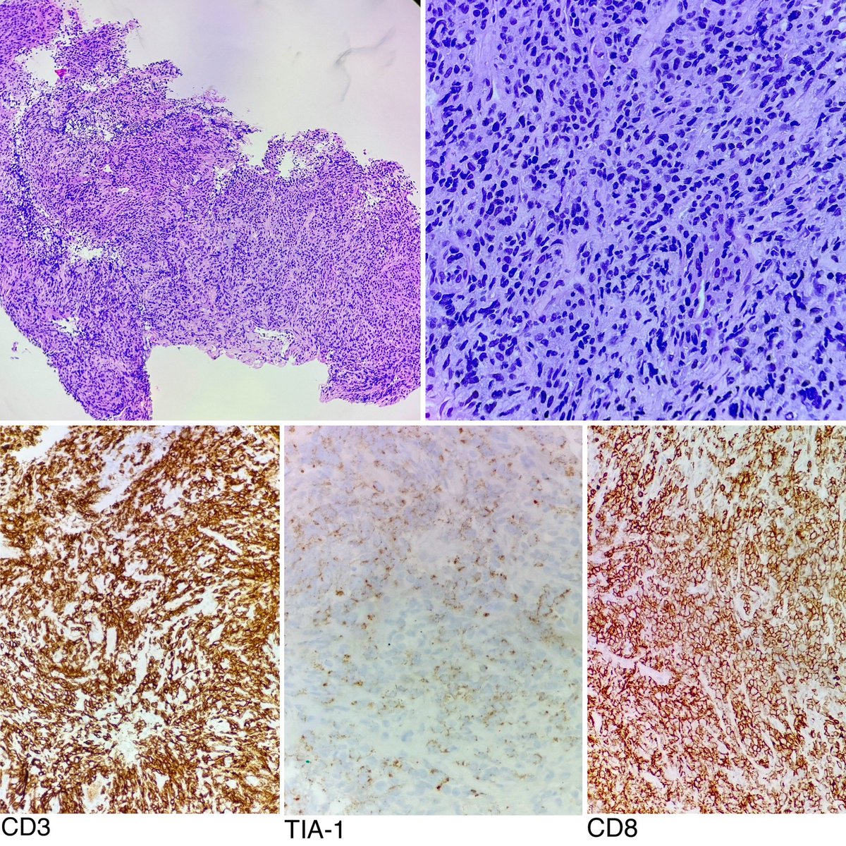 What’s the diagnosis?
80+ yo man, with cough and multifocal solid to cavitary PET avid lung nodules.
RLL endobronchial mass, smooth but fungating, resected with rigid tools and cryo.
Path slides with sheets of small blue cells and IHC stains as listed.