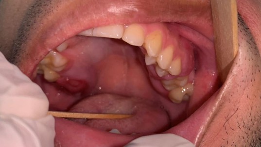 PenafortPaulo's tweet photo. A young man from the Brazilian Amazon presented with multifocal gingival Burkitt lymphoma as the first sign of undiagnosed HIV. Limited access to care and late diagnosis led to death within 15 days. Read our recent publication here: https://t.co/XfD1Z5PaoQ https://t.co/lmPoXLXDjb