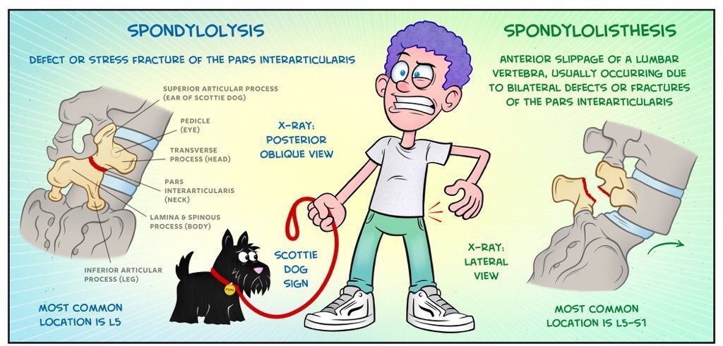 Spondylolysis and Spondylolisthesis

<a href="/spinalinjuries/">Spinal Injuries Association</a>