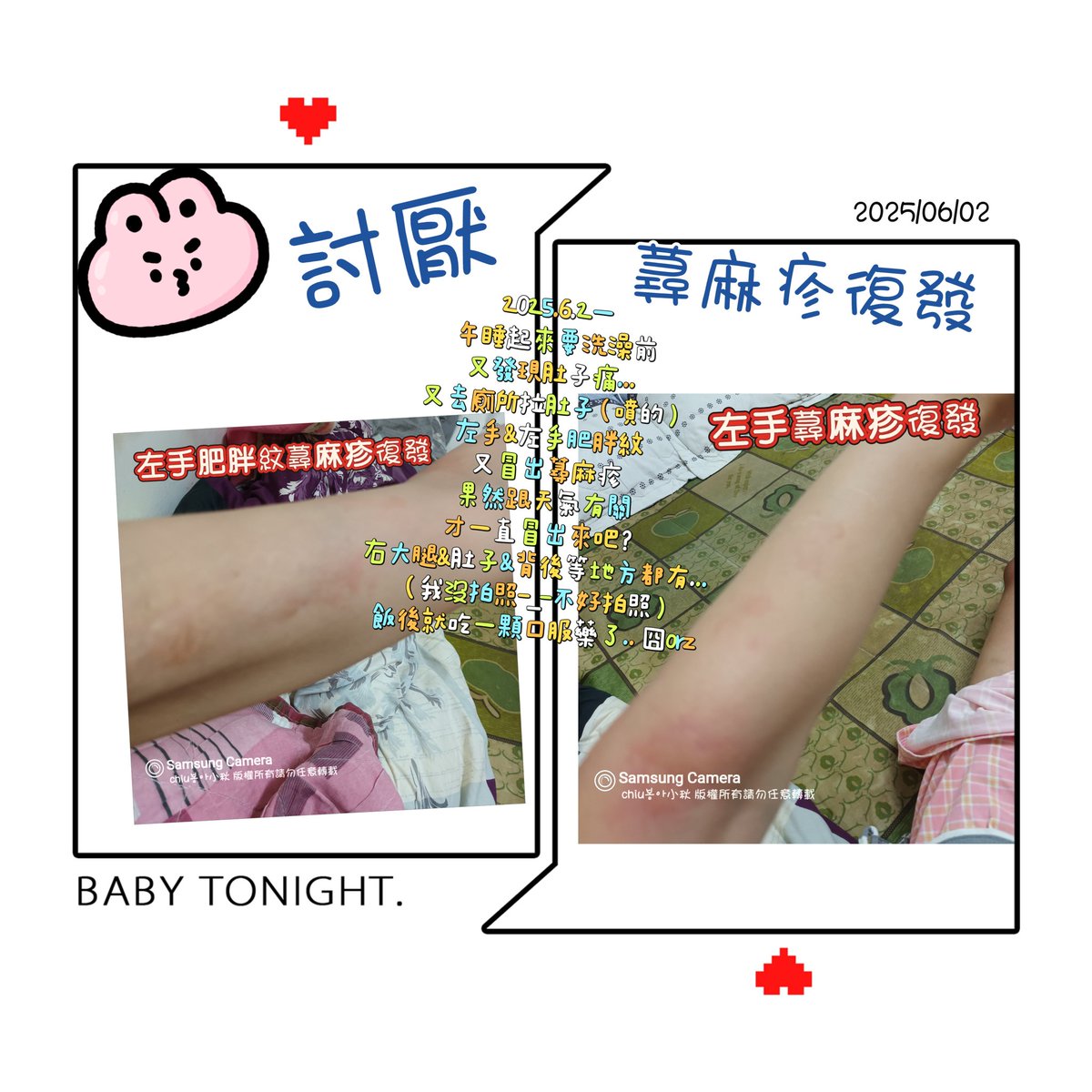 xia0giu's tweet photo. 2025.6.2一
午睡起來要洗澡前
又發現肚子痛... 
又去廁所拉肚子（噴的）
左手&amp;左手肥胖紋
又冒出 #��麻疹
果然跟天氣有關
才一直冒出來吧？
右大腿&amp;肚子&amp;背後等地方都有....
（我沒拍照-_-不好拍照）
飯後就吃一顆口服藥了.. 囧orz https://t.co/ZqPbEkZupO