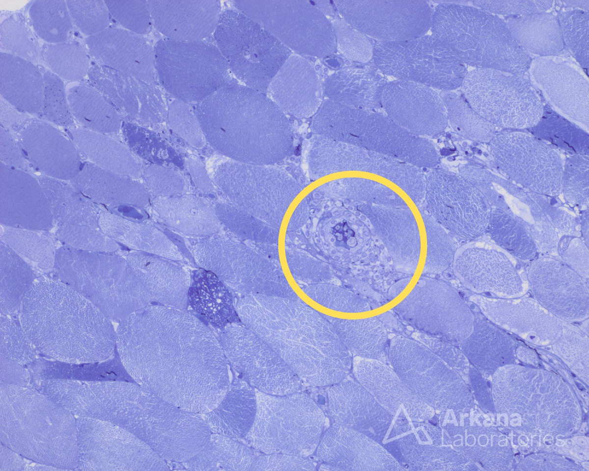 #NeuroNotes Patient is 68 year old woman who presented with progressive proximal weakness since August and severe x2 weeks.
- Past medical history included: hyperthyroidism, hyperlipidemia, herpes simplex, hypertension.
- Medications included: statin (discontinued 5 days before