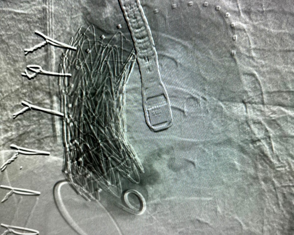 Indiana Surgery -Indiana Univ School of Medicine (@iu_surgery) on Twitter photo 🙌Congratulations to our <a href="/iu_ctsurgery/">IUSM Division of CT Surgery</a> and <a href="/iu_vascular/">Division of Vascular Surgery at IUSM</a> team for performing a FIRST for Indiana using <a href="/WLGore/">Gore</a> ARISE-II ascending aortic stent graft!
Currently, it is an investigational device as part of an FDA Pivotal study in the United States.
#IUSurgery #IUCTSurgery 🙌Congratulations to our <a href="/iu_ctsurgery/">IUSM Division of CT Surgery</a> and <a href="/iu_vascular/">Division of Vascular Surgery at IUSM</a> team for performing a FIRST for Indiana using <a href="/WLGore/">Gore</a> ARISE-II ascending aortic stent graft!
Currently, it is an investigational device as part of an FDA Pivotal study in the United States.
#IUSurgery #IUCTSurgery