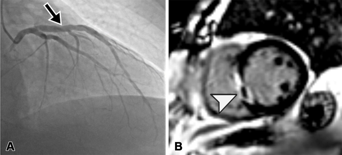 RadioGraphics (@radiographics) on Twitter photo Acute chest pain with clean coronary arteries? Discover the imaging workflow—CT angiography for anatomy, cardiac MRI for tissue, and stress tests for ischemia. bit.ly/3FsGMkj Acute chest pain with clean coronary arteries? Discover the imaging workflow—CT angiography for anatomy, cardiac MRI for tissue, and stress tests for ischemia. bit.ly/3FsGMkj