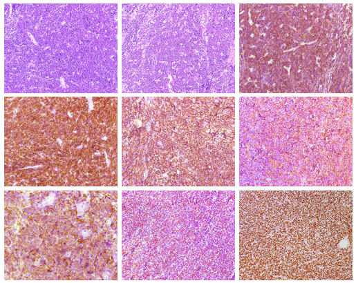 PenafortPaulo's tweet photo. Immunohistochemical analysis showed positivity for LCA, CD20, PAX-5, BCL-6, CD10, and MYC. Ki-67, was greater than 95 %. In situ hybridization for Epstein–Barr virus (EBV) and immunohistochemical markers CD3, CD138, VS38c, MUM-1, BCL-2, Cyclin D1, and TdT were negative. https://t.co/2HGxXfGNB6