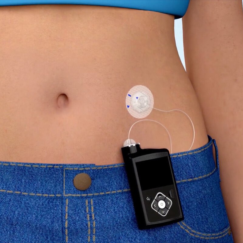 askddietitian's tweet image. Insulin pumps are one of the greatest innovation in healthcare in recent times … once again thumbs up to science ….. with this you don’t have to inject yourself insulin but it’s delivered intermittently via the device ….
