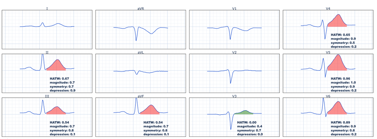 Robert Herman, MD (@roberthermanmd) on Twitter photo <a href="/ecgandrhythmRoe/">Dr. Andreas Roeschl</a> Early anterior STEMI due to occlusion of the mid LAD (Type 1) with wraparound morphology.
An excellent example of hyperacute T-waves and why looking at millimiters of ST-elevation is not necessary! <a href="/ecgandrhythmRoe/">Dr. Andreas Roeschl</a> Early anterior STEMI due to occlusion of the mid LAD (Type 1) with wraparound morphology.
An excellent example of hyperacute T-waves and why looking at millimiters of ST-elevation is not necessary!