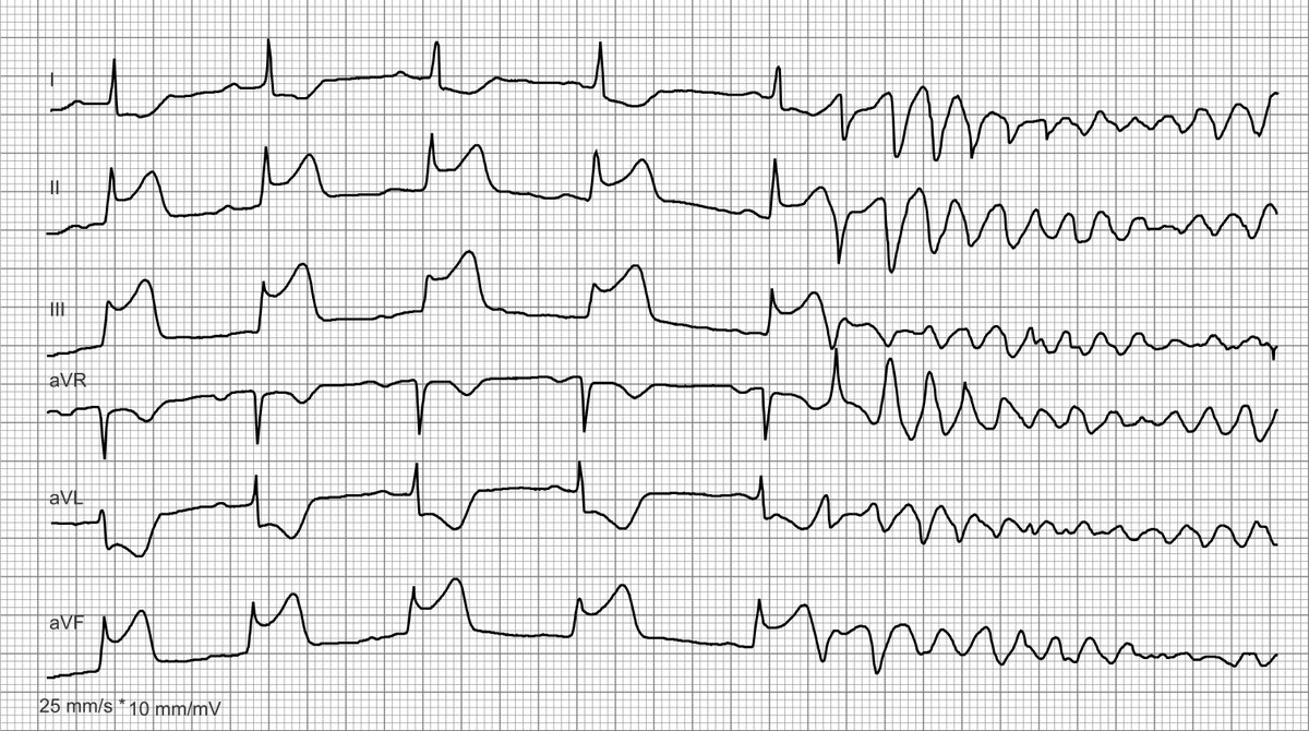 I found this ECG in my archive. I think it's from Platform X, but I can't remember exactly. PMcardio has helped me to improve the very poor quality of the ECG. The diagnosis is not difficult, but the ECG is very clear 😀 and i had to share it