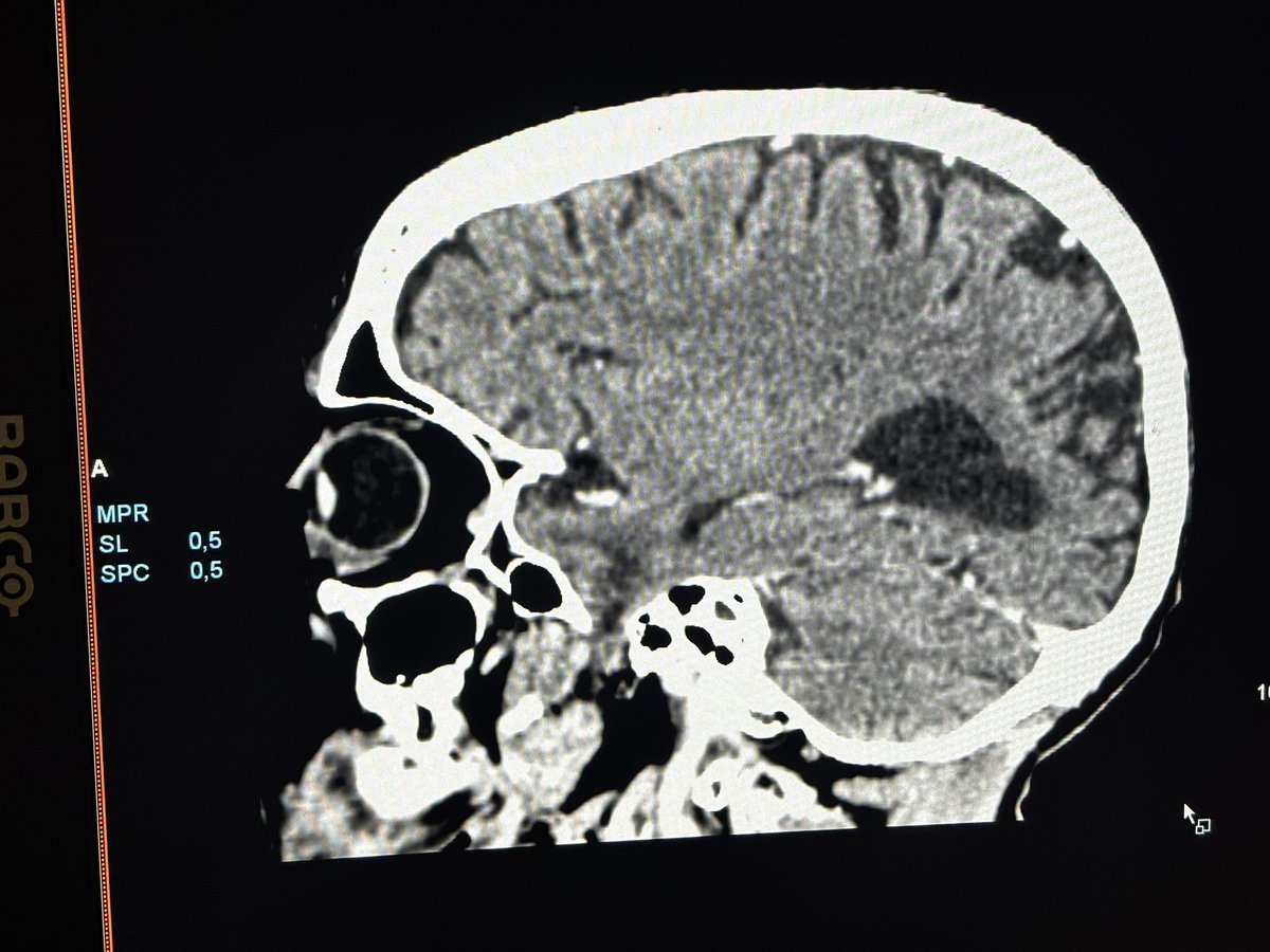 🧠 Not everything temporal is a tumor — when a congenital encephalocele mimics a mass.

82F with no trauma history, presenting with new-onset temporal lobe epilepsy.
Initially suspected metastatic lesion.

CT revealed:
🔸 Small left medial temporal bone encephalocele, with