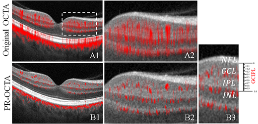 TVST Journal (@arvotvst) on Twitter photo In the New Frontiers in Optical Coherence Tomography Issue bit.ly/3u6vw7v, David Huang et al. <a href="/CaseyEye/">OHSU Casey Eye</a> study the Anatomy of the Macular Ganglion Cell Layer Plexus on Projection-Resolved Optical Coherence Tomographic Angiography, tvst.arvojournals.org/article.aspx?a…. In the New Frontiers in Optical Coherence Tomography Issue bit.ly/3u6vw7v, David Huang et al. <a href="/CaseyEye/">OHSU Casey Eye</a> study the Anatomy of the Macular Ganglion Cell Layer Plexus on Projection-Resolved Optical Coherence Tomographic Angiography, tvst.arvojournals.org/article.aspx?a….