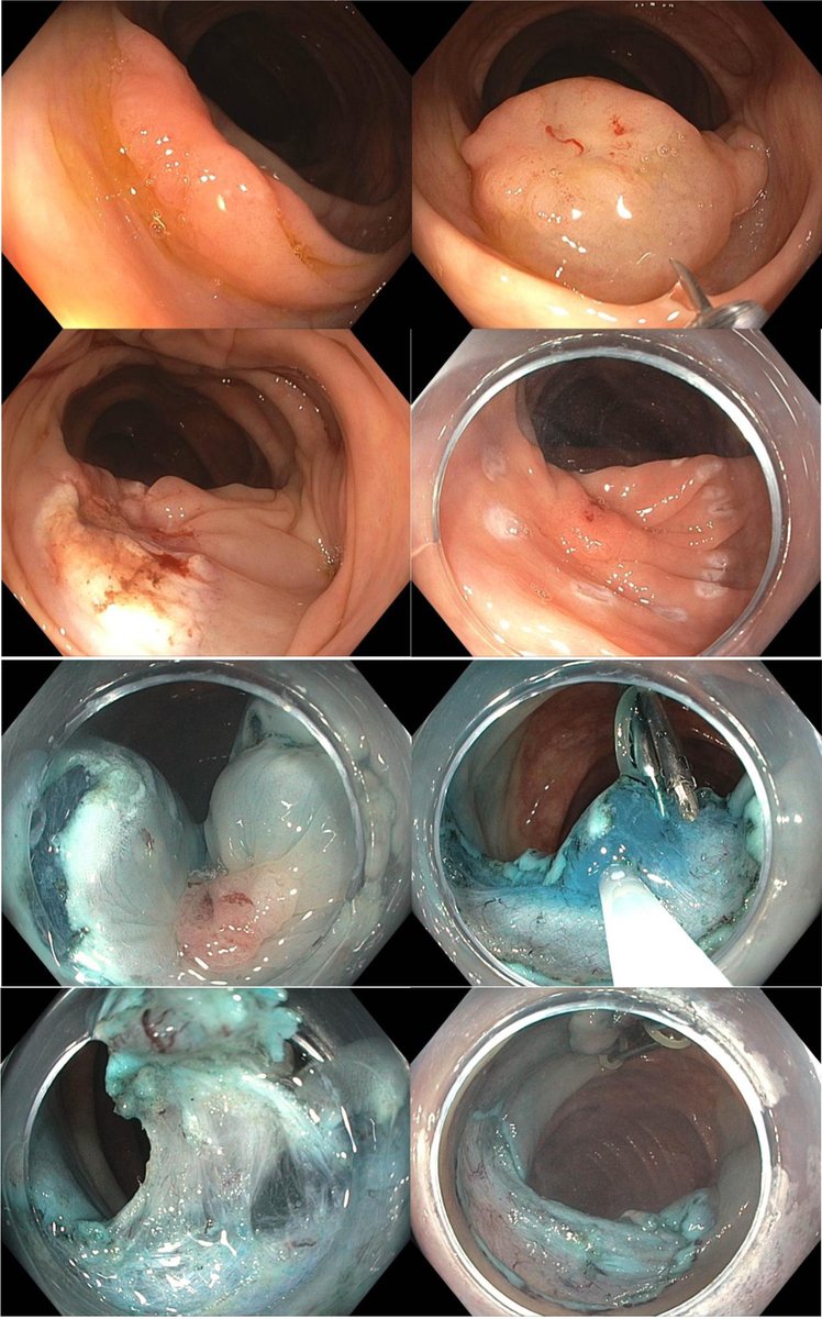 TIGE (@aga_tige) on Twitter photo β Take some time to read one of the most viewed articles from our journal
π Polypectomy Techniques for Pedunculated and Nonpedunculated Polyps
π ow.ly/u75650W1Sp5 β Take some time to read one of the most viewed articles from our journal
π Polypectomy Techniques for Pedunculated and Nonpedunculated Polyps
π ow.ly/u75650W1Sp5