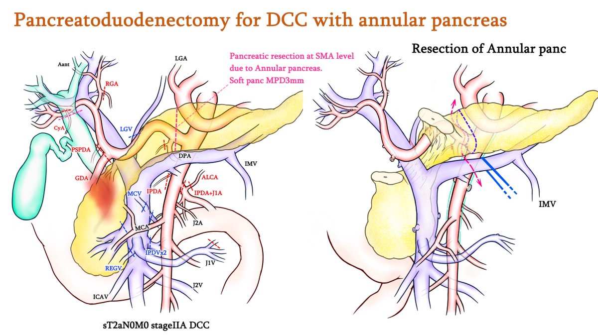 In cases of #pancreatoduodenectomy for annular pancreas, achieving a clean resection of pancreatic tissue can sometimes be extremely challenging. The key is to review carefully preoperative imaging and proceed with precision during surgery. There is no alternative.