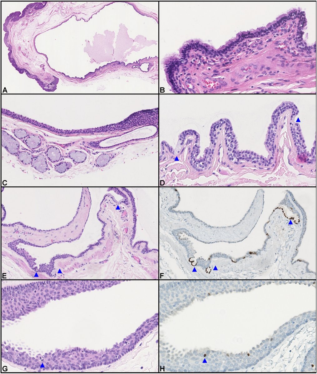 New in #HumPathol: Penile Cysts: A Review of Clinicopathological Features and Differential Diagnosis. sciencedirect.com/science/articl… #pathology #PathTwitter #PathX #GUpath