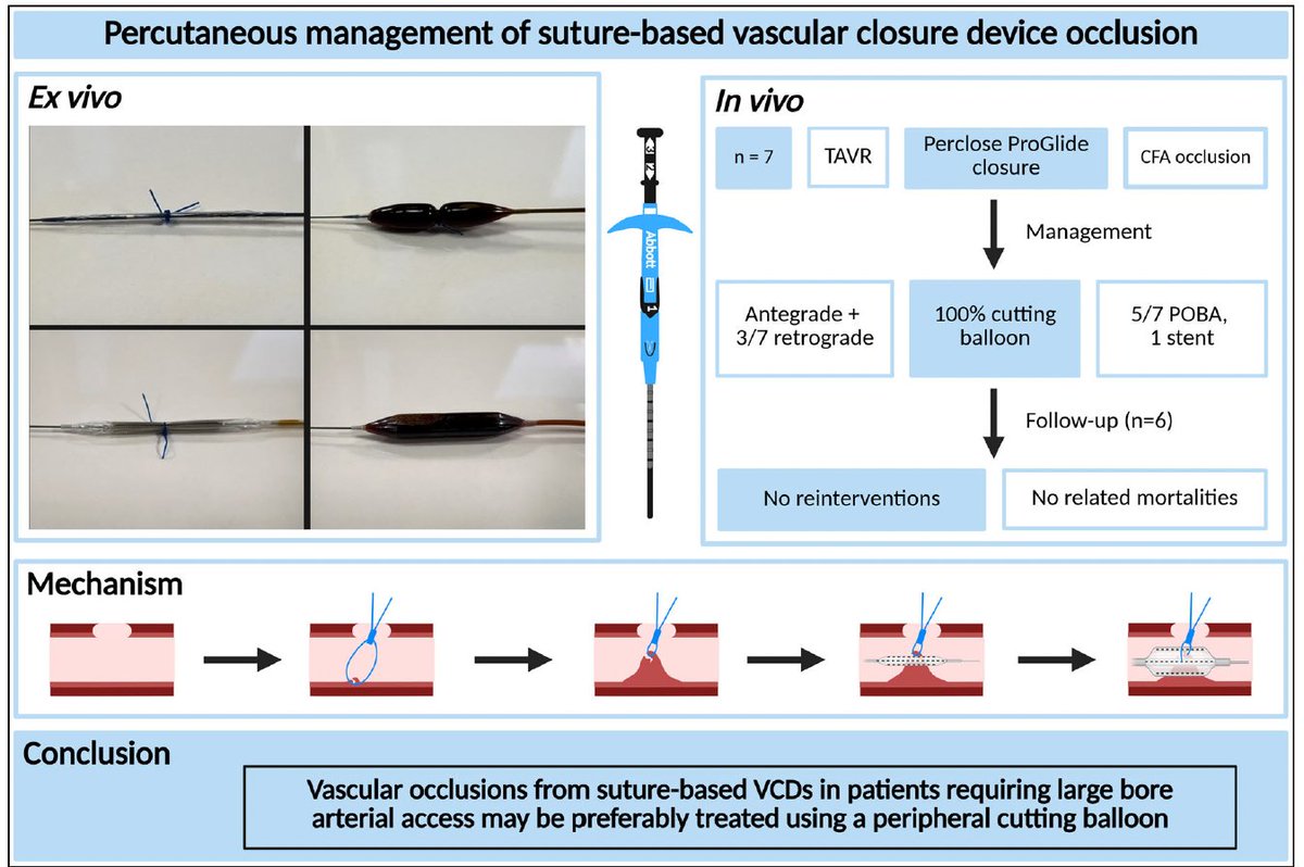 When closure becomes complication:
7 cases of Perclose-induced CFA occlusion post-TAVR managed percutaneously with cutting balloon angioplasty. Benchtop model confirms mechanism.
No surgery. No reintervention.
🧠💡
🔗 DOI: 10.1002/ccd.31598
#TAVR #VCD #CardioTwitter