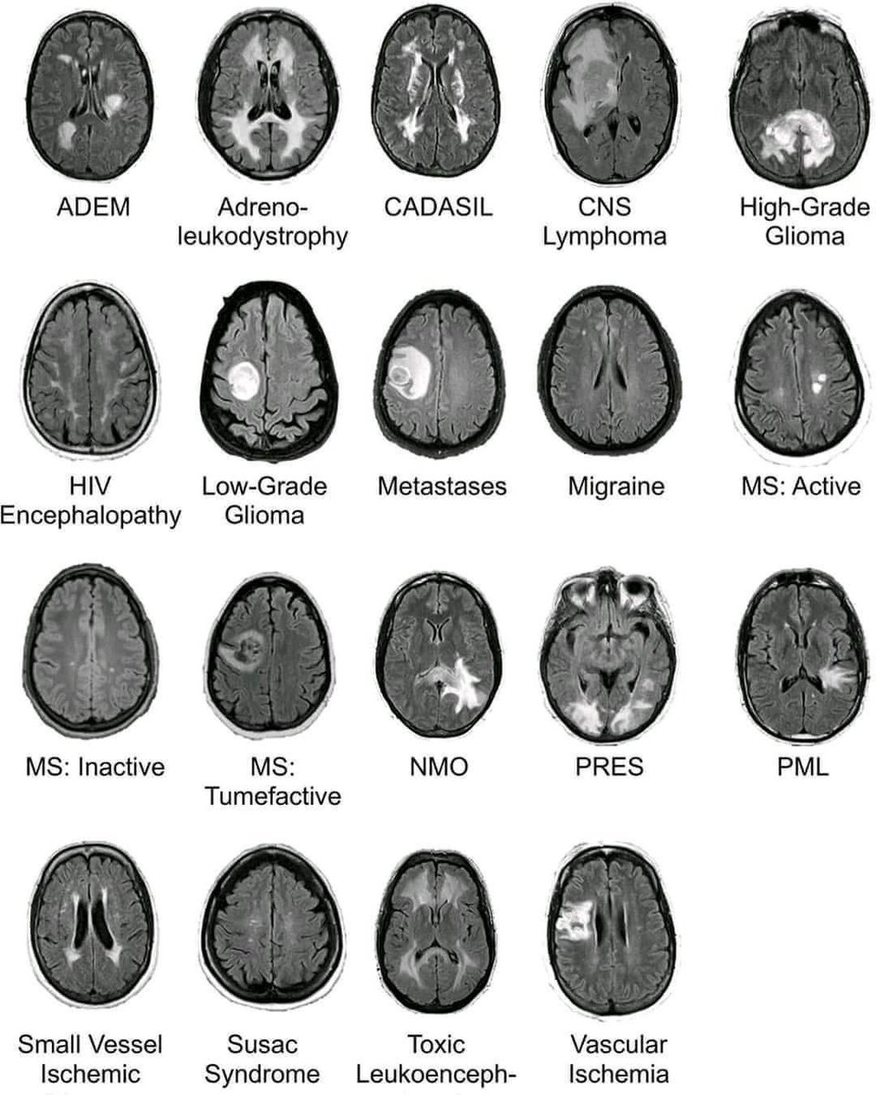 ENARM_intensivo's tweet image. 💢PATRONES  TOMOGRAFICOS  DE  PATOLOGÍAS  CEREBRALES

#ENARM_INTENSIVO #ESTUDIA_MEDICINA