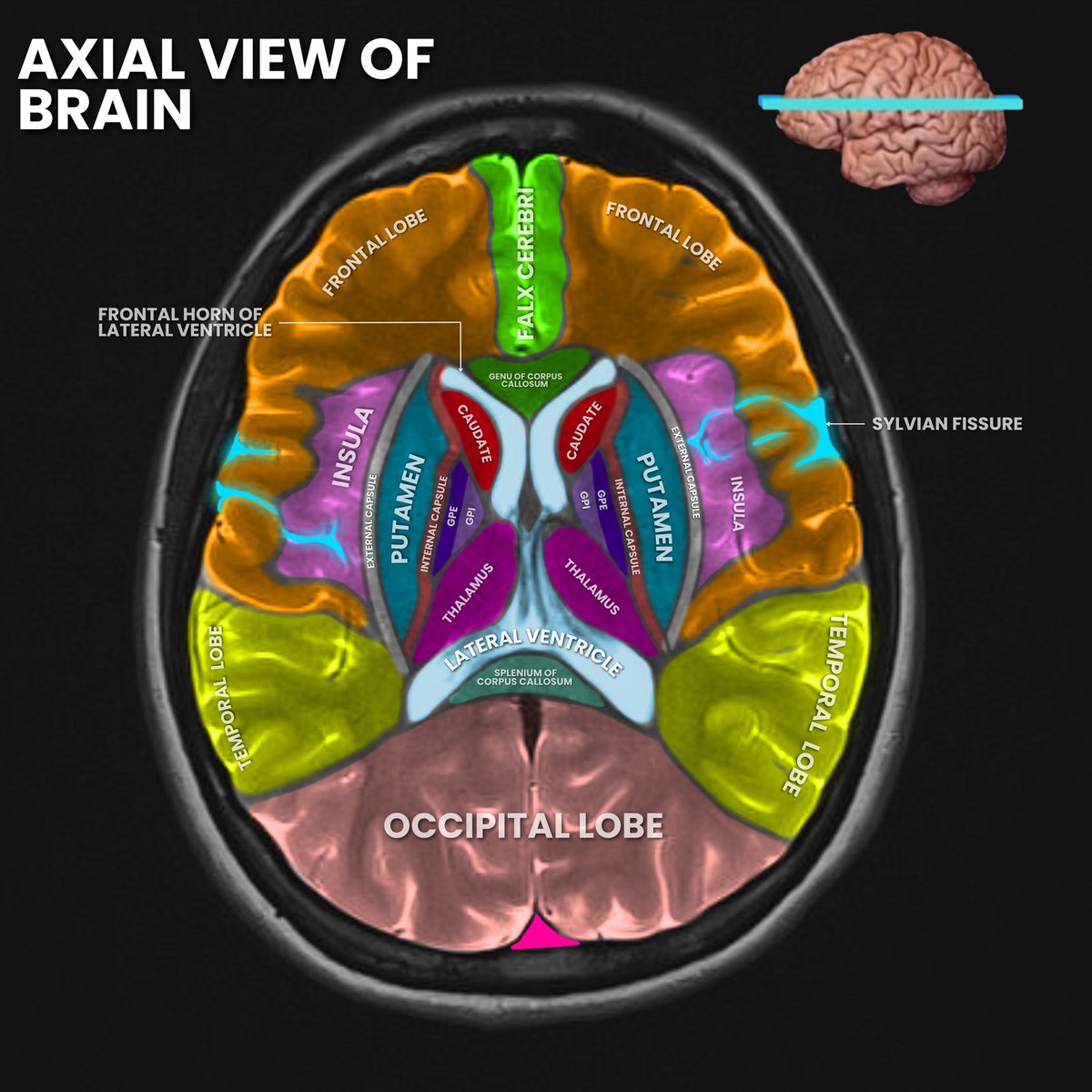 DrZNeurosurgery's tweet image. The 3 planes of a brain MRI. To best localize a lesion, a neurosurgeon will look at these three views to triangulate an approach. #Radiology #MRI #Radiologist #Neurosurgeon #Brain #BrainScan #Anatomy #AnatomyAndPhysiology #NeuroAnatomy @neurosurgatlas