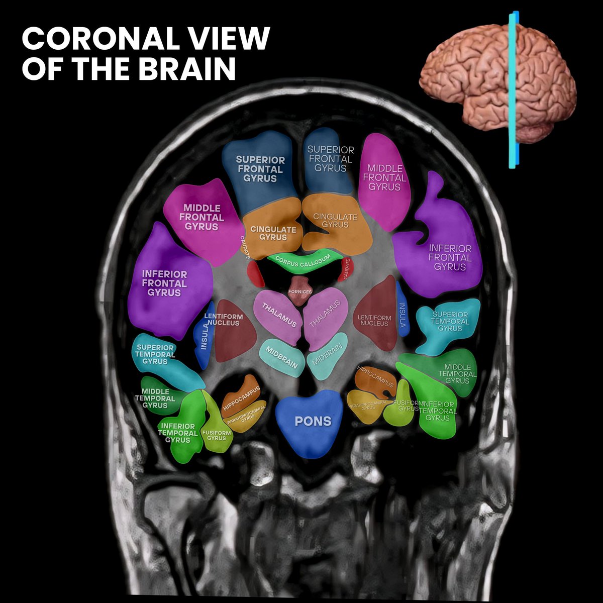 Dr. Z Neurosurgery (@drzneurosurgery) on Twitter photo The 3 planes of a brain MRI. To best localize a lesion, a neurosurgeon will look at these three views to triangulate an approach. #Radiology #MRI #Radiologist #Neurosurgeon #Brain #BrainScan #Anatomy #AnatomyAndPhysiology #NeuroAnatomy <a href="/neurosurgatlas/">Neurosurgical Atlas</a> The 3 planes of a brain MRI. To best localize a lesion, a neurosurgeon will look at these three views to triangulate an approach. #Radiology #MRI #Radiologist #Neurosurgeon #Brain #BrainScan #Anatomy #AnatomyAndPhysiology #NeuroAnatomy <a href="/neurosurgatlas/">Neurosurgical Atlas</a>
