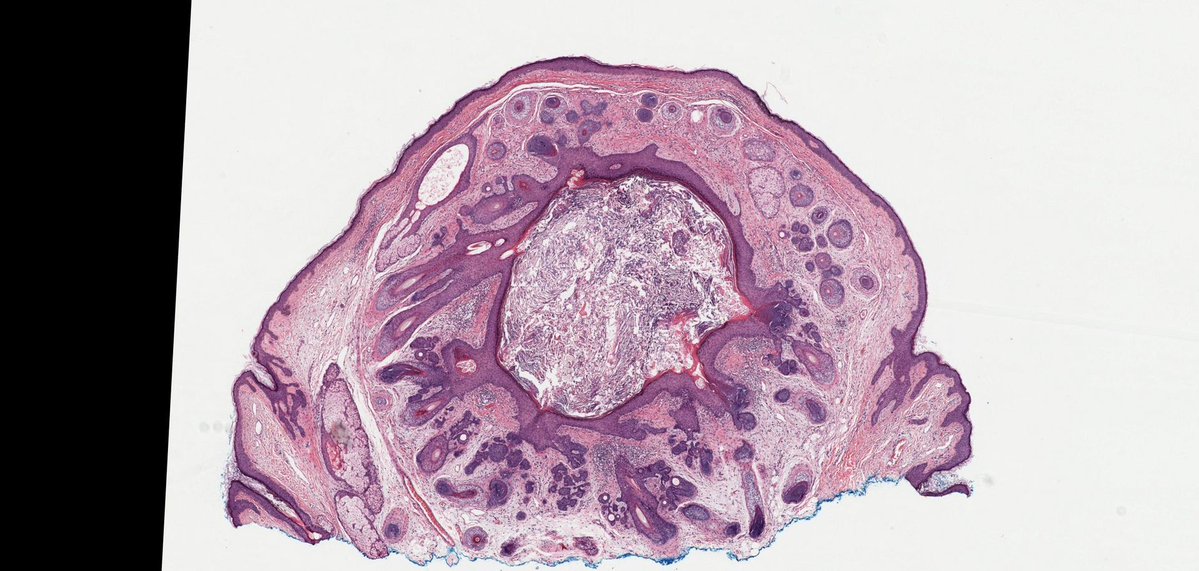 Jerad Gardner, MD (@jmgardnermd) on Twitter photo What's this beautiful adnexal tumor? Reply w/ diagnosis, then check answer here youtu.be/wQlreSbY79g. WSI digital slide on <a href="/pathpresenter/">pathpresenter.com</a> pathpresenter.net/public/display…. <a href="/mydermpath/">Raj Singh MD</a> #pathology #pathologists #pathTwitter #dermpath #dermatology #dermatologia #dermtwitter What's this beautiful adnexal tumor? Reply w/ diagnosis, then check answer here youtu.be/wQlreSbY79g. WSI digital slide on <a href="/pathpresenter/">pathpresenter.com</a> pathpresenter.net/public/display…. <a href="/mydermpath/">Raj Singh MD</a> #pathology #pathologists #pathTwitter #dermpath #dermatology #dermatologia #dermtwitter