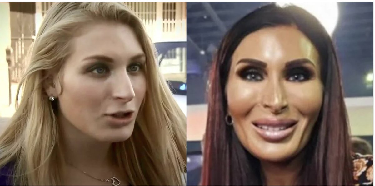 elev4tedconcept's tweet photo. @LauraLoomer @boulderpolice This is a photo of you before and after your operations. I wonder where your mind was when you thought it would help? https://t.co/o8Swx5LP8x