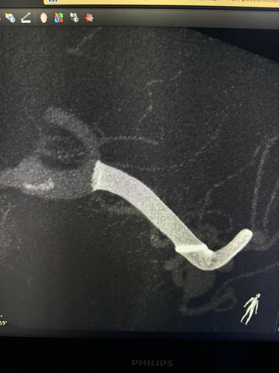 Boris pabon (@boris_pabon) on Twitter photo 4challenging cases a good team & good tools were the solution. Terrific work at LINNC Paris. <a href="/LINNConline/">LINNC online 🧠</a> <a href="/Angio_team/">Angioteam</a> <a href="/terumoneuro/">Terumo Neuro</a> <a href="/GalaxyThera/">Galaxy Therapeutics</a> <a href="/MDTLATAM/">Medtronic LatAm</a> <a href="/Rapid__Medical/">Rapid Medical</a> 4challenging cases a good team & good tools were the solution. Terrific work at LINNC Paris. <a href="/LINNConline/">LINNC online 🧠</a> <a href="/Angio_team/">Angioteam</a> <a href="/terumoneuro/">Terumo Neuro</a> <a href="/GalaxyThera/">Galaxy Therapeutics</a> <a href="/MDTLATAM/">Medtronic LatAm</a> <a href="/Rapid__Medical/">Rapid Medical</a>