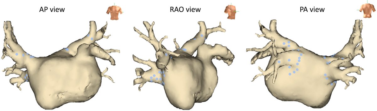 Heart Rhythm Case Reports (@hrs_casereports) on Twitter photo A Case Report of Persistent Phrenic Nerve Injury by Pulsed Field Ablation: Lessons from Anatomical Reconstruction and Electrode Positioning
<a href="/AkihikoNogami/">Akihiko Nogami</a>
heartrhythmcasereports.com/article/S2214-… A Case Report of Persistent Phrenic Nerve Injury by Pulsed Field Ablation: Lessons from Anatomical Reconstruction and Electrode Positioning
<a href="/AkihikoNogami/">Akihiko Nogami</a>
heartrhythmcasereports.com/article/S2214-…