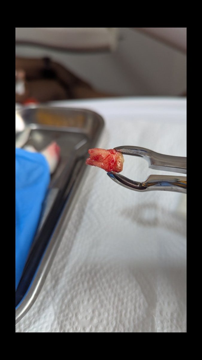 PascalTiyo's tweet image. Extraction de dent de sagesse..
C'est possible d'éviter d'en arriver là en venant consulter plus tôt
