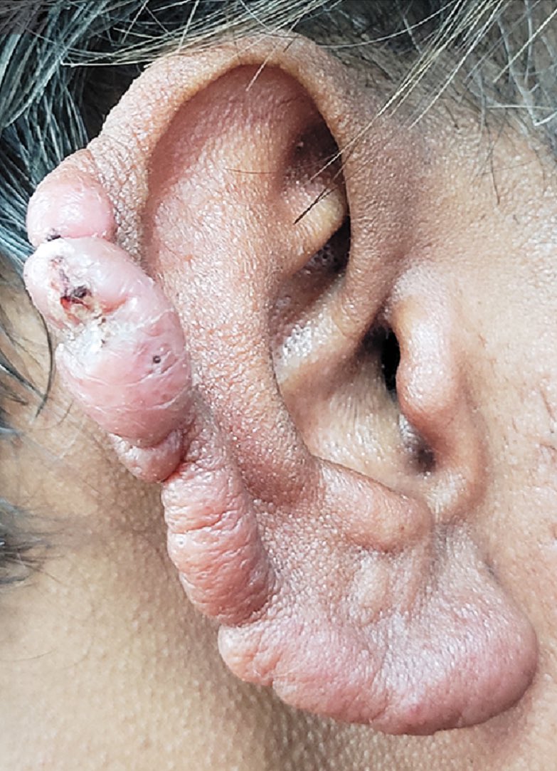 ❔⁉️A 40-year-old man presens with 1-year history of painless swelling of his earlobes

Diagnosis ?

Image <a href="/NEJM/">NEJM</a>