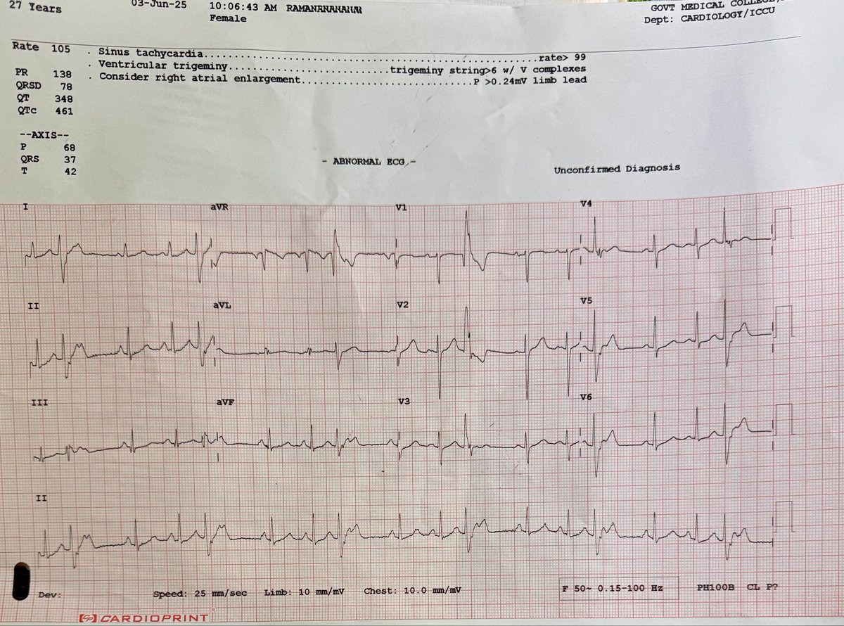Rajiv Arora (@rajivasr) on Twitter photo 27 F / 9 months Pregnant with Palpitations
Fascicular vs SVCs vs OT-PVCs or else <a href="/SergioPinski/">Sergio Pinski</a> <a href="/ecgrhythms/">Arnel Carmona</a> <a href="/syamkumarmd/">Syamkumar</a> <a href="/ecgandrhythmRoe/">Dr. Andreas Roeschl</a> <a href="/KostekMilan/">Milan Koštek</a> <a href="/anunay_cardio/">Anunay Gupta MD, DM</a> 27 F / 9 months Pregnant with Palpitations
Fascicular vs SVCs vs OT-PVCs or else <a href="/SergioPinski/">Sergio Pinski</a> <a href="/ecgrhythms/">Arnel Carmona</a> <a href="/syamkumarmd/">Syamkumar</a> <a href="/ecgandrhythmRoe/">Dr. Andreas Roeschl</a> <a href="/KostekMilan/">Milan Koštek</a> <a href="/anunay_cardio/">Anunay Gupta MD, DM</a>