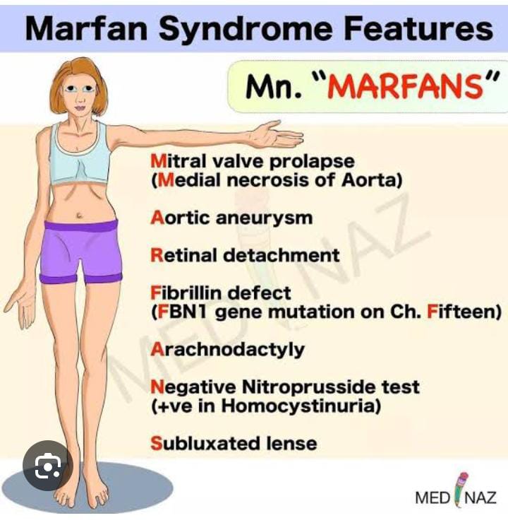 Mnemonics of Features of Marfan Syndrome using the word 'Marfans'.