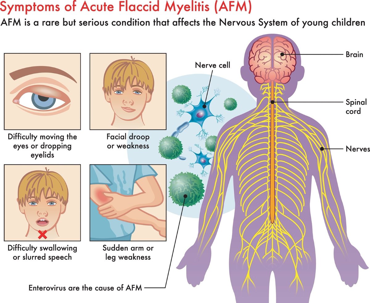 NewsMedical's tweet image. Gaps in surveillance leave European children at risk of acute flaccid myelitis news-medical.net/news/20250602/… #AcuteFlaccidMyelitis #AFM #paralysis #childhealth #Europe #enterovirus #publichealth #neurology #infectiousdisease @Eurosurveillanc