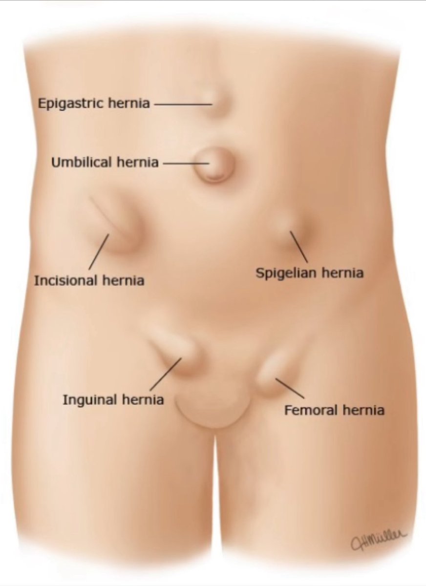 Types of Hernia 💥