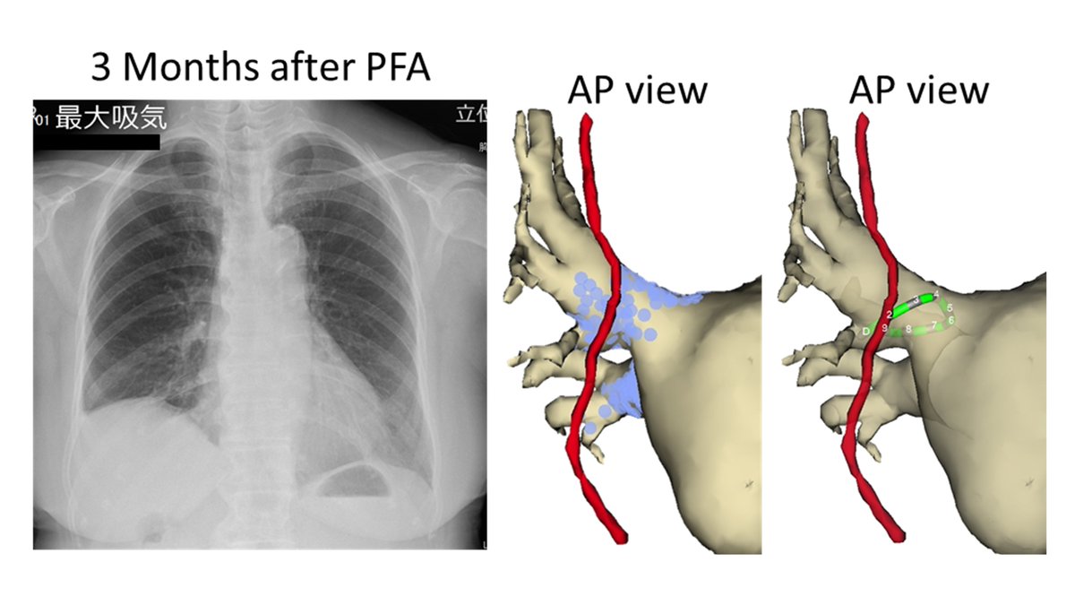 Persistent Phrenic Nerve Injury by Pulsed Field Ablation: Lessons from Anatomical Reconstruction and Electrode Positioning. HRCR. Oda, et al. 
heartrhythmcasereports.com/article/S2214-…
