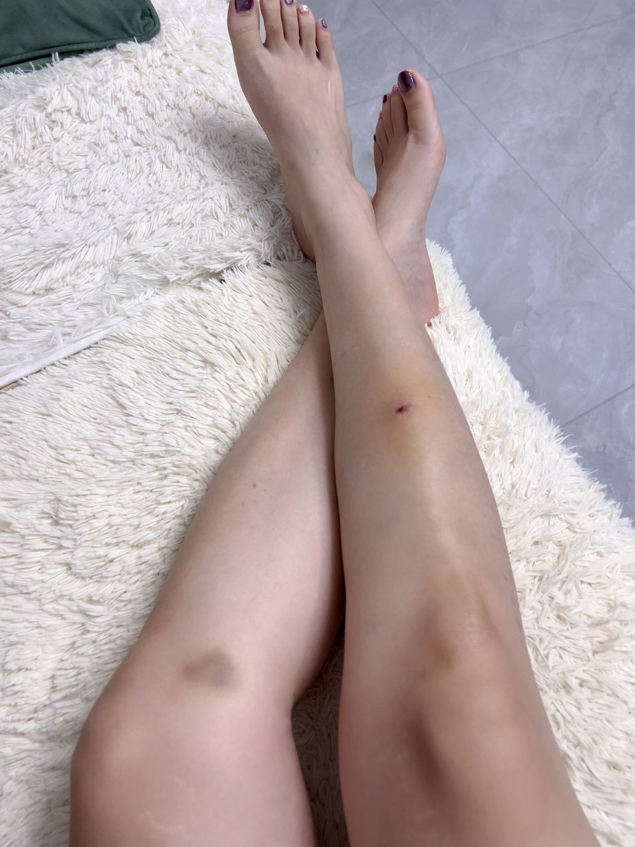 我的腿跟了我真是太惨了😭