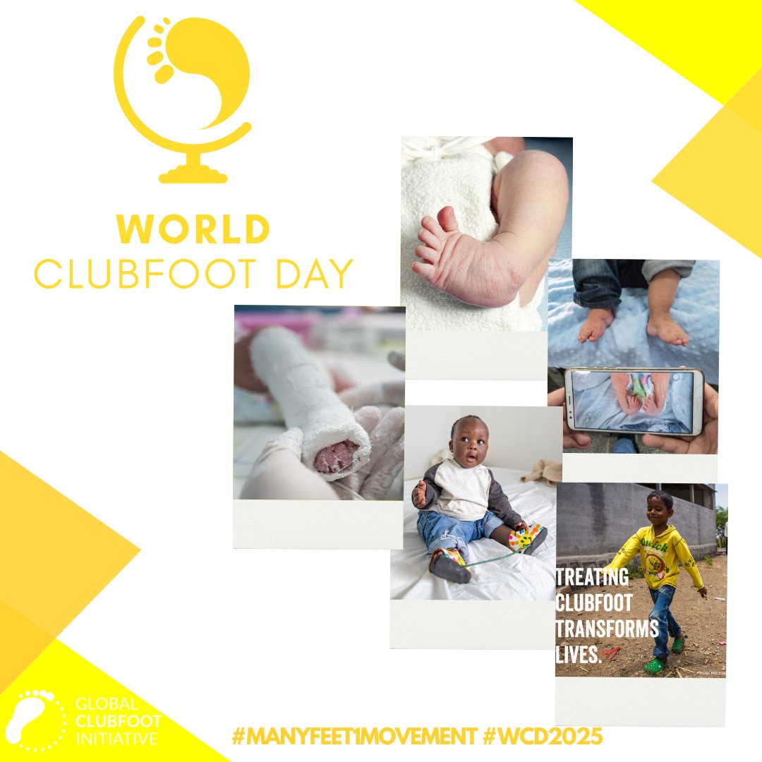 Happy #WorldClubfootDay! This year our theme is Access and Awareness - Clubfoot Care for Every Child: Timely, Effective, and Accessible. Our latest article explores the barriers—and the solutions. 

📰 ow.ly/5rw450W391U 

#DisabilityInclusion #ChildHealth #WorldClubfootDay