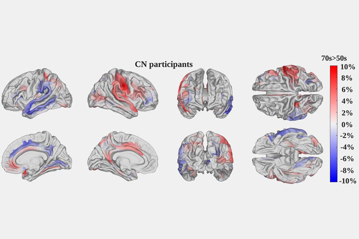 BiotechMN's tweet image. Miden cómo envejece el #cerebro con #InteligenciaArtificial. #BiotechMN #neurociencia @InstitutoCajal @NeuroAlc @seggeriatria @semeg_es @EnvejecerCSIC @MayoresUDP biotechmagazineandnews.com/miden-como-env…