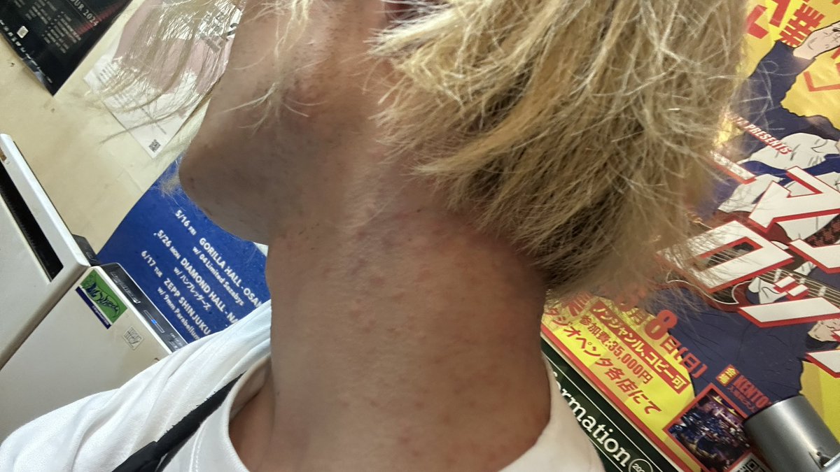 謎の蕁麻疹…｡ﾟ(ﾟ´ω`ﾟ)ﾟ｡
画像は苦手な人は開かないで｡ﾟ(ﾟ´ω`ﾟ)ﾟ｡
病院いかなきゃか、、、
