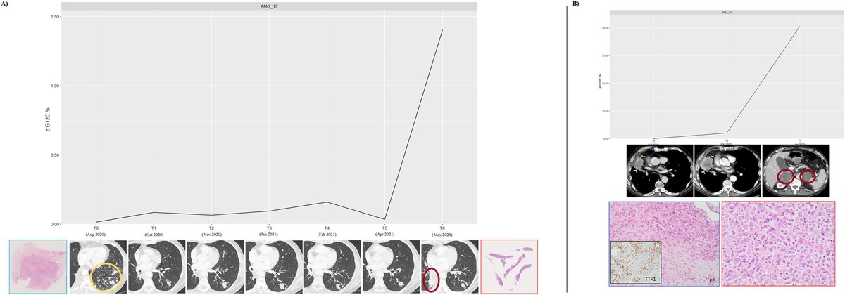 ACS Journal Cancer (@journalcancer) on Twitter photo New #OpenAccess research from <a href="/UmbertoMalapel1/">Umberto Malapelle</a> et al in time for the conclusion of #ASCO25 | Circulating tumor DNA dynamic variation predicts sotorasib efficacy in KRASp.G12C-mutated advanced non-small cell lung cancer acsjournals.onlinelibrary.wiley.com/doi/10.1002/cn…
<a href="/OncoAlert/">OncoAlert</a> #LCSM New #OpenAccess research from <a href="/UmbertoMalapel1/">Umberto Malapelle</a> et al in time for the conclusion of #ASCO25 | Circulating tumor DNA dynamic variation predicts sotorasib efficacy in KRASp.G12C-mutated advanced non-small cell lung cancer acsjournals.onlinelibrary.wiley.com/doi/10.1002/cn…
<a href="/OncoAlert/">OncoAlert</a> #LCSM