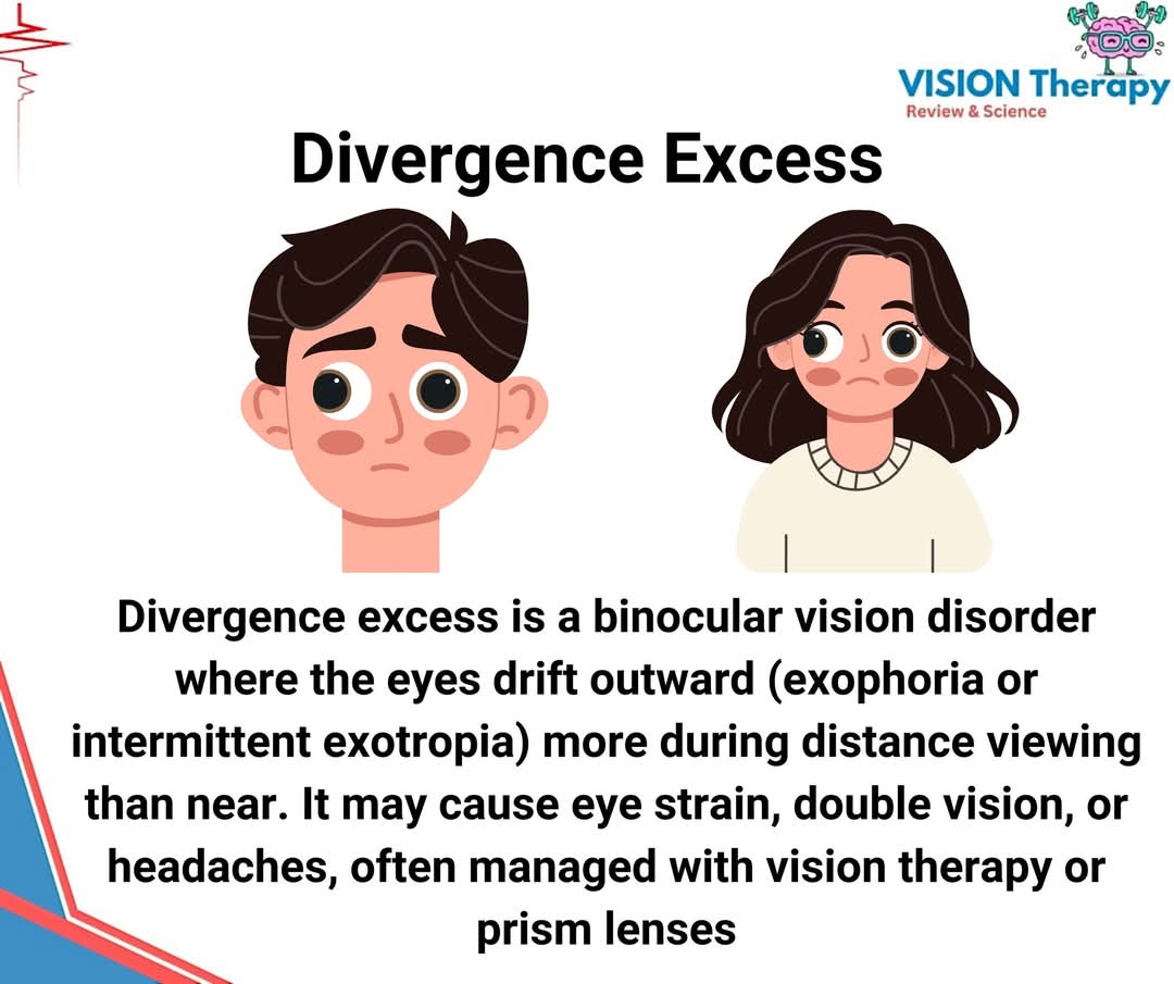 VTRSofficial's tweet photo. Struggling with Double Vision or Eye Strain? You may have Divergence Excess, causing your eyes to drift outward.
#VTRS #divergenceexcess #DE #BV #binocularvision #nsbvd #nsbd #nonstrabismicbinocularvisiondiorder #nonstrabismicbinocularanomalies #eyecare https://t.co/pqDPTrxPuv