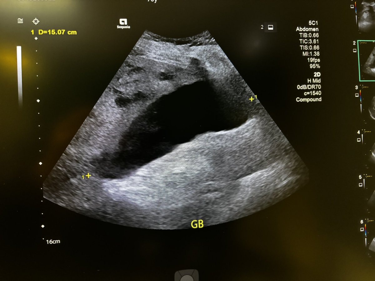 🟡 Obstructive jaundice &amp; weight loss — formal sonography reveals a pancreatic head mass.

70F with 10 kg weight loss over 6 months, obstructive jaundice, fever, and a positive Murphy’s sign.
🧪 Clinical concern: ascending cholangitis or periampullary malignancy.

🩻  Formal