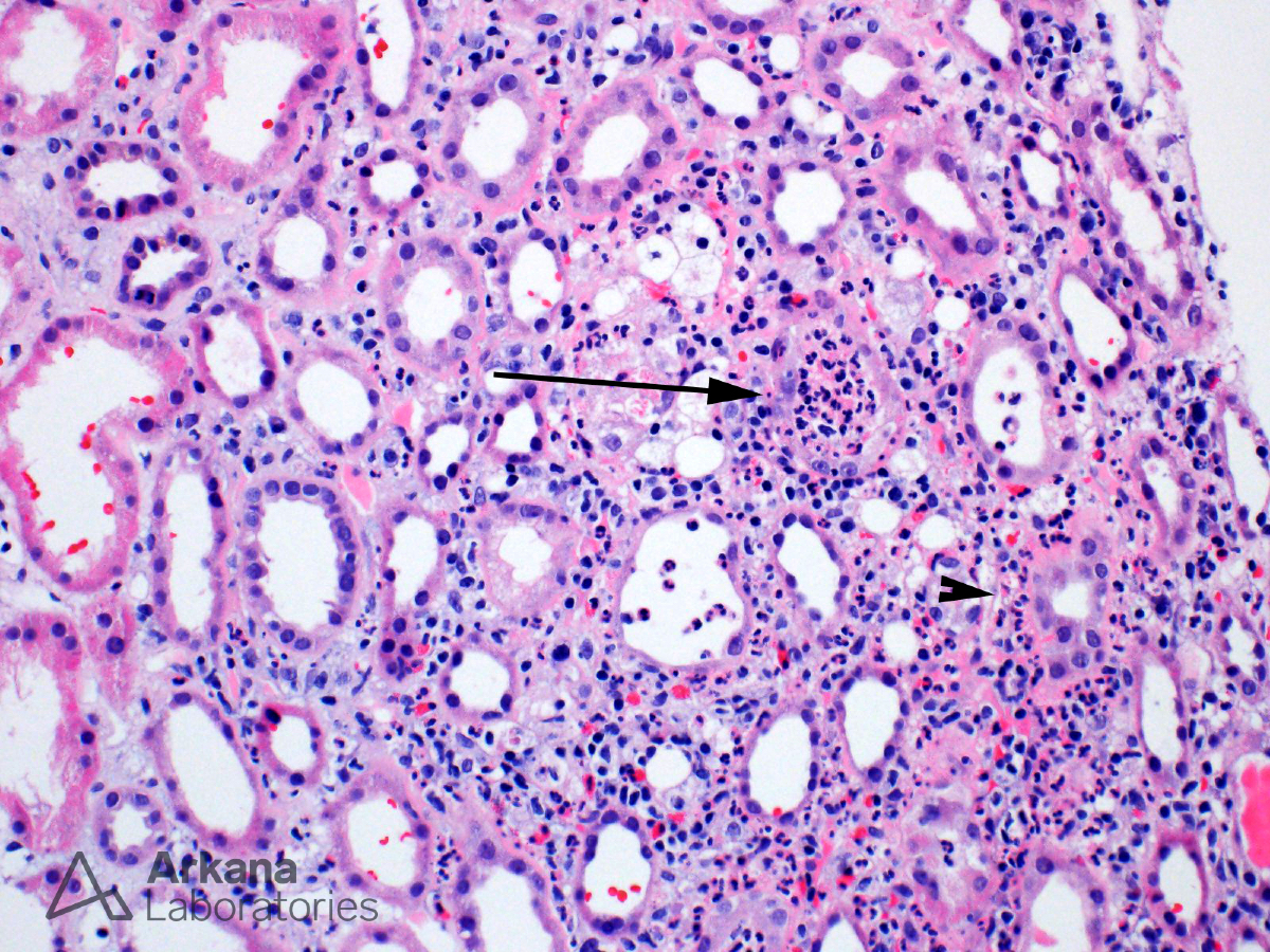 The renal biopsy image shows features characteristic of acute pyelonephritis. There is a neutrophil-rich interstitial inflammatory infiltrate and evidence of acute tubular injury. Some tubular lumens are filled with neutrophils (arrow), and in some areas, neutrophils encircle the