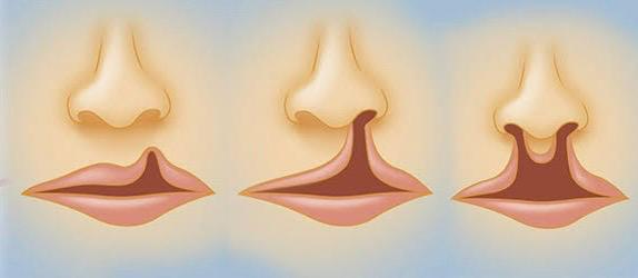 HUGV/Ebserh realiza mutirão inédito de cirurgias de fissura de lábio e palato em pacientes adultos. x.gd/in0s2