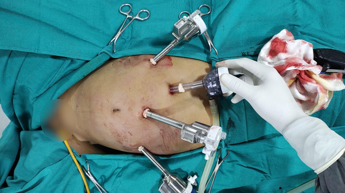 A 7-year-old male child diagnosed at age 3 years with recurrent UTIs had a left-sided congenital megaureter and diverticulum and right side reflux and small diverticulum. At age 3 We did   only  left-sided laparoscopic tapering ureteric reimplantation and diverticulecomy. Four